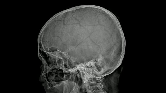 Film X-Ray Skull of Human and Blank Area