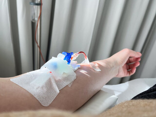 Hand with cannula during medical infusion of ferritin. IV drip photo. Woman in hospital having a...