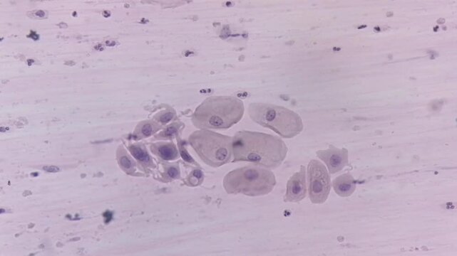 Photomicrographic footage of Paps smear: Inflammatory smear with HPV related changes. Cervical cancer. SCC