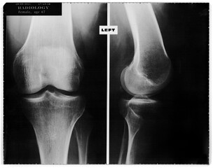 Real X-Ray Left knee Radiograph. Radiography film of a 47-year-old woman left knee revealing modest gonarthrosis manifestations. 