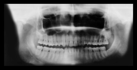 Orthopantomography (OPG) or Radiography of the oral cavity. Real Orthopantomogram or x-Ray film of dental arches of a man with signs of diffuse periodontitis and bone resorption of the root tips. 