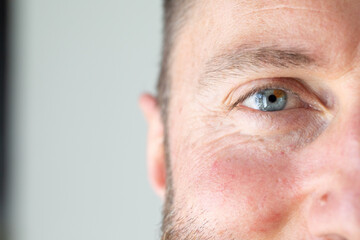 Close-up of man showing blue eye with brown spot: health and vision concept