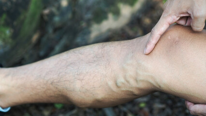 Varicose veins on the legs of men