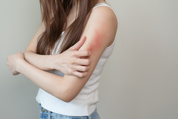 Close-up of young woman scratch her arm have a red rash