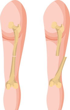 An open fracture is when a broken bone pierces through the skin, exposing the bone and increasing the risk of infection. A closed fracture does not penetrate the skin