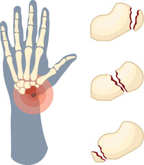 A scaphoid fracture is a break in the scaphoid bone, one of the small carpal bones in the wrist located near the base of the thumb