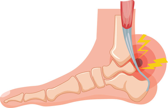 アキレス腱」の写真素材 | 2,125件の無料イラスト画像 | Adobe Stock