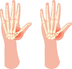 A Rolando fracture is a comminuted, intra-articular fracture at the base of the first metacarpal bone of the thumb, often forming a "T" or "Y" shape on radiographs