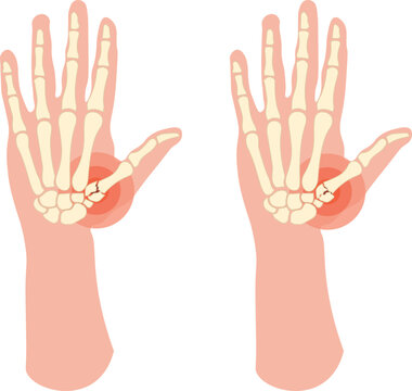 A Rolando fracture is a comminuted, intra-articular fracture at the base of the first metacarpal bone of the thumb, often forming a "T" or "Y" shape on radiographs