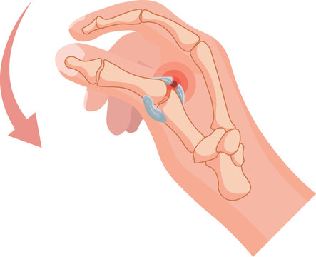 Skier&rsquo;s thumb is an injury to the ulnar collateral ligament of the thumb&rsquo;s metacarpophalangeal joint and typically occurs due to a sudden forceful abduction or hyperextension of the thumb