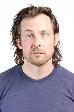 Adult male with Bell's Palsy or facial paralysis