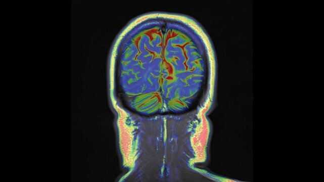 Coloured  coronal view T2-weighted magnetic resonance imaging (MRI) scan of a normal brain.
