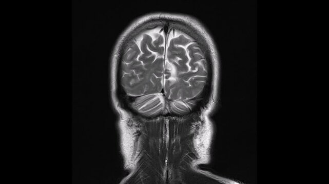 coronal view T2-weighted magnetic resonance imaging (MRI) scan of a normal brain.