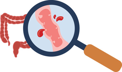 colonic polyp, lower gastrointestinal bleeding, diverticulitis, 