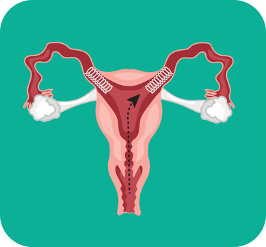 essure micro insert for permanent birth control