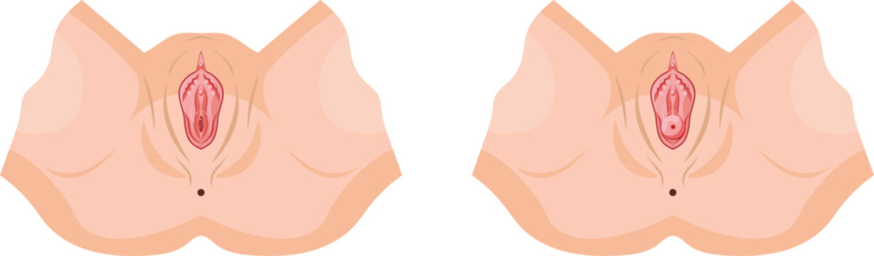 normal genital compared to genital with uterine prolapse