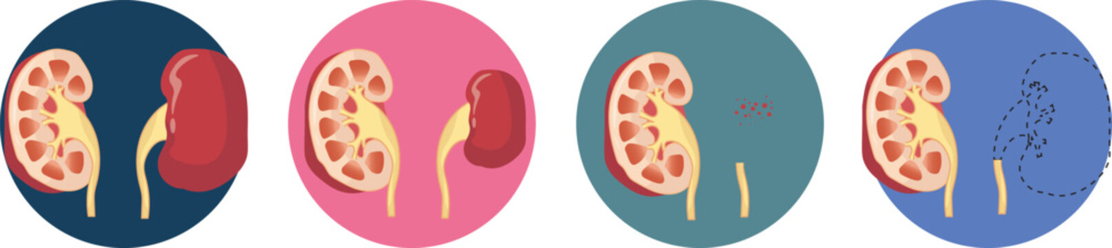 most common congenital renal malformation