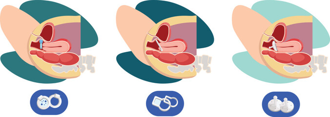 type of pessary inserted in the vagina for uterine prolapse prevention
