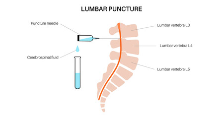 Lumbar puncture spinal tap