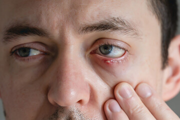 Man with infected chalazion (stye, barley) eye on lower eyelid