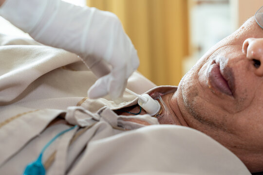 Hands of nurse clean the tracheostomy tube with cotton. Patients who have undergone a tracheostomy for intubation in hospital
