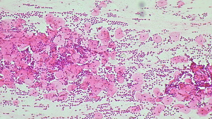 Human cervical squamous epithelial cells, pap smear, NILM (class II non specific chronic inflammation) under a microscope view for education histology. Human tissue.