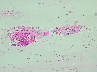 Human cervical squamous epithelial cells, pap smear, NILM (class II non specific chronic...