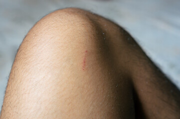 Fototapeta premium The skin on the feet is injured due to scratches