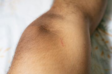 Fototapeta premium The skin on the feet is injured due to scratches