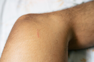 Naklejka premium The skin on the feet is injured due to scratches