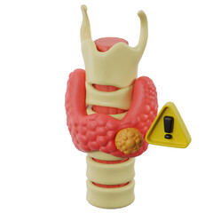 Thyroid nodules and cancer. 3d illustration