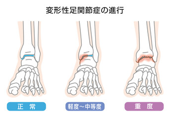 変形性足関節症の進行　イラスト