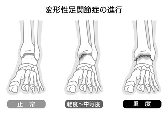 変形性足関節症の進行　イラスト　モノトーン