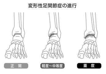変形性足関節症の進行　イラスト　モノトーン