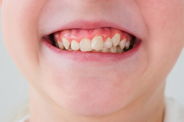 Child has crooked teeth. The concept of crowding of molars.