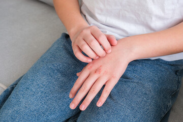 The child has dry skin on his hands.
