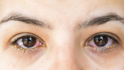 Obraz premium Close-up of human eyes with conjunctivitis, showing redness, irritation, and yellow discharge. The inflamed eyes indicate an eye infection, possibly bacterial or viral, requiring medical attention