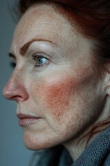 Fototapeta premium Portrait of a woman with sun spots on her face, highlighting a common skin condition that can be addressed through skincare and dermatology solutions.