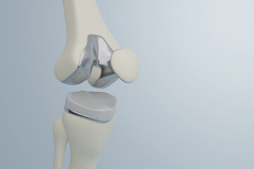 Close-up of knee joint with metal implant in a medical setting.