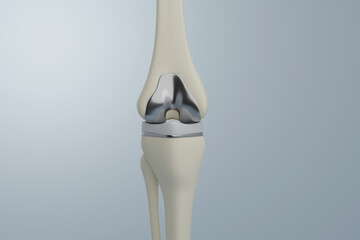 Knee replacement surgery with metal and plastic joint implants. 3D illustration