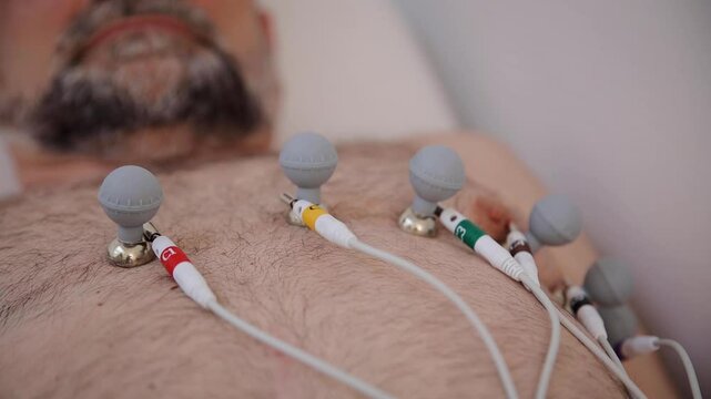 Close-up of electrocardiogram electrodes attached to a patient's chest for heart monitoring. Medical checkup technology in use for cardiovascular diagnostics and healthcare analysis