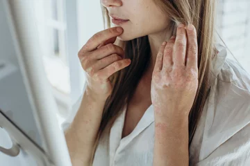 Skin problem, acne, psoriasis. Women's hands with red skin, itching. © nuzza11