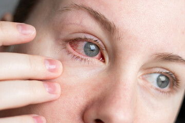 Close up of female face with one red eye suffering from infection conjunctivitis