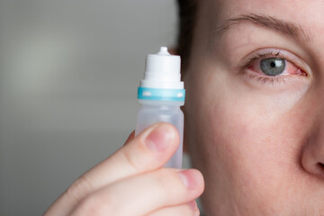 Close up of a woman applying eyedrops on red infected eye with conjunctivitis at home