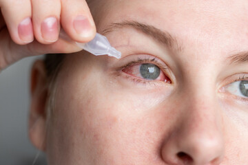 Close up of a woman applying eyedrops on red infected eye with conjunctivitis at home
