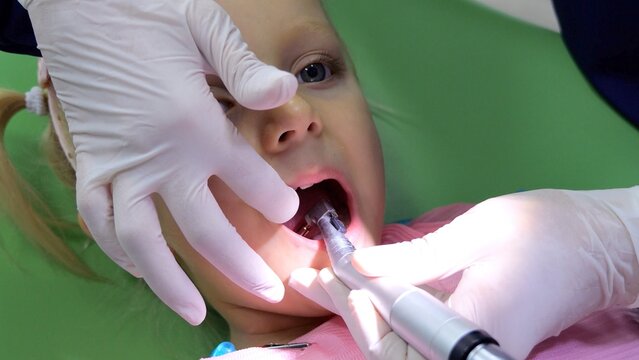 Professional pediatric dentist curing dental filling using specialized polymerization lamp while treating young patient's teeth in modern dental clinic