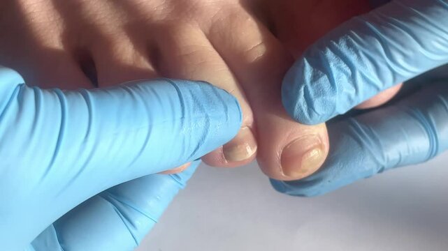nail fungus, toenail with fungal infection or damage, doctor in blue medical glove examines diseased toenails