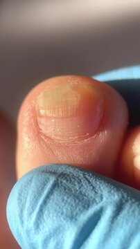 nail fungus, toenail with fungal infection or damage, doctor in blue medical glove examines diseased toenails
