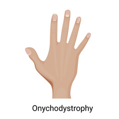 Obraz premium Onychodystrophy of the fingernail vector illustration.