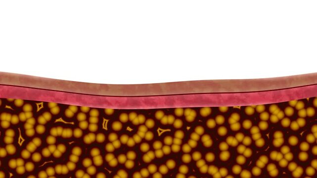 Medical illustration of fat cells under the skin, showing adipose tissue structure and layers of the epidermis with a reduction in fat layer.
